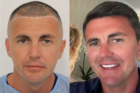 Billie Faiers’ husband Greg Shepherd shows off results of hair transplant in before and after pics