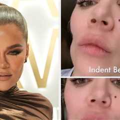 Khloé Kardashian Showed Off The Result Of Her Facial Filler After Evening Out An “Indentation” In..