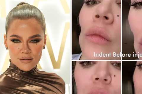 Khloé Kardashian Showed Off The Result Of Her Facial Filler After Evening Out An “Indentation” In..