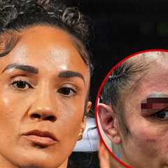 Amanda Serrano Shares Gruesome Injury Pic After Loss to Katie Taylor