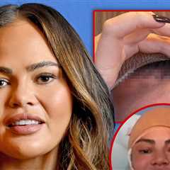 Chrissy Teigen Addresses Bandaged Face After Surgery