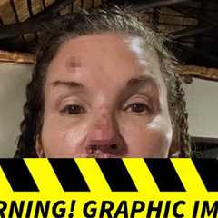 Janice Dickinson's Photos of Alleged Injuries From Nasty Fall on 'I'm A Celebrity'