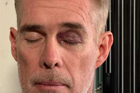 Joe Buck reveals black eye hidden by ESPN makeup artist after Seahawks-49ers game