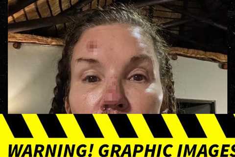 Janice Dickinson's Photos of Alleged Injuries From Nasty Fall on 'I'm A Celebrity'