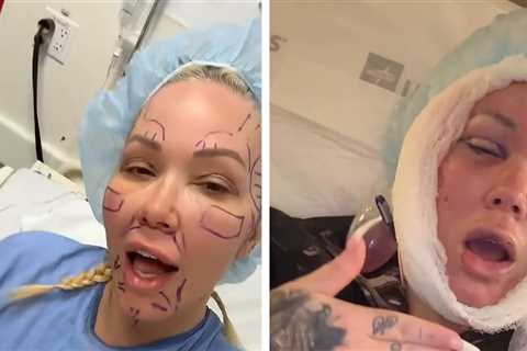 Bunnie XO Shares Gnarly Footage of Facelift