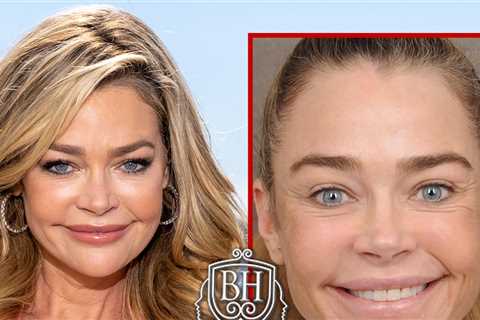 Denise Richards' Before-and-After Pics Are Giving Her Surgeon's Business a Lift