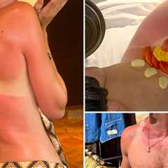 Celebrity Sunburns Guess Who!
