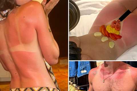 Celebrity Sunburns Guess Who!